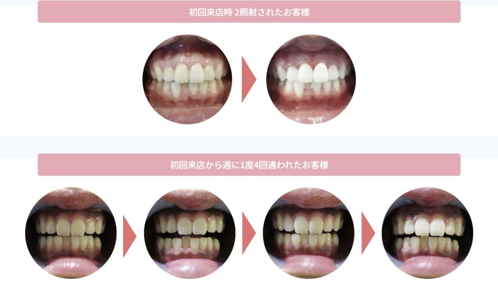 セルフホワイトニングで効果を実感する回数・期間は？